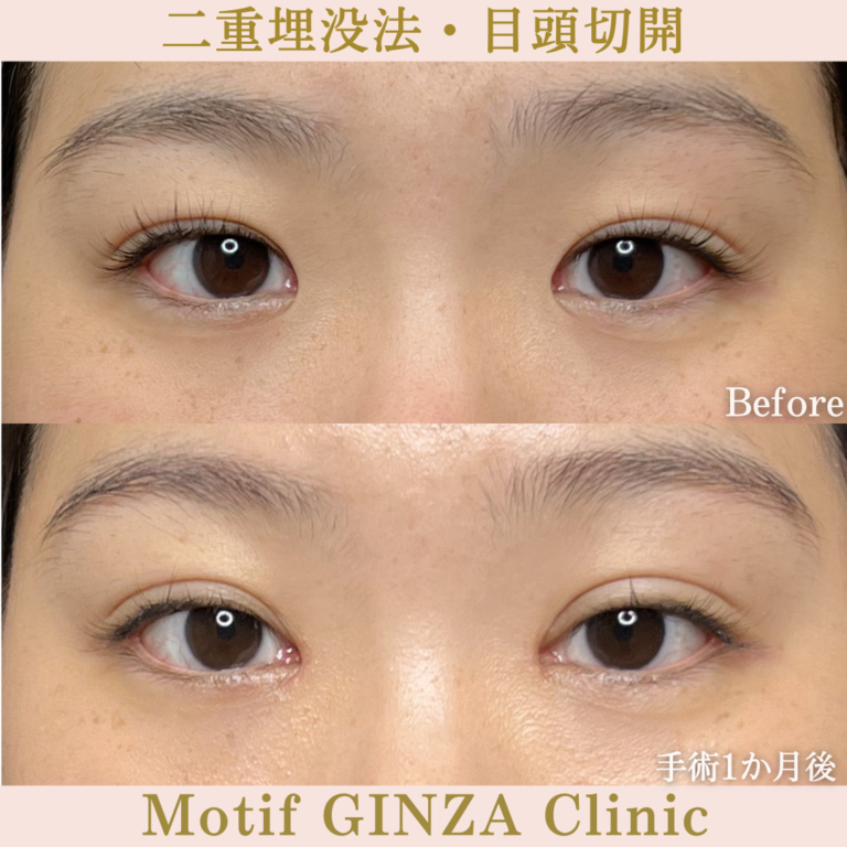 二重切開法・目頭切開（手術6か月）の写真4