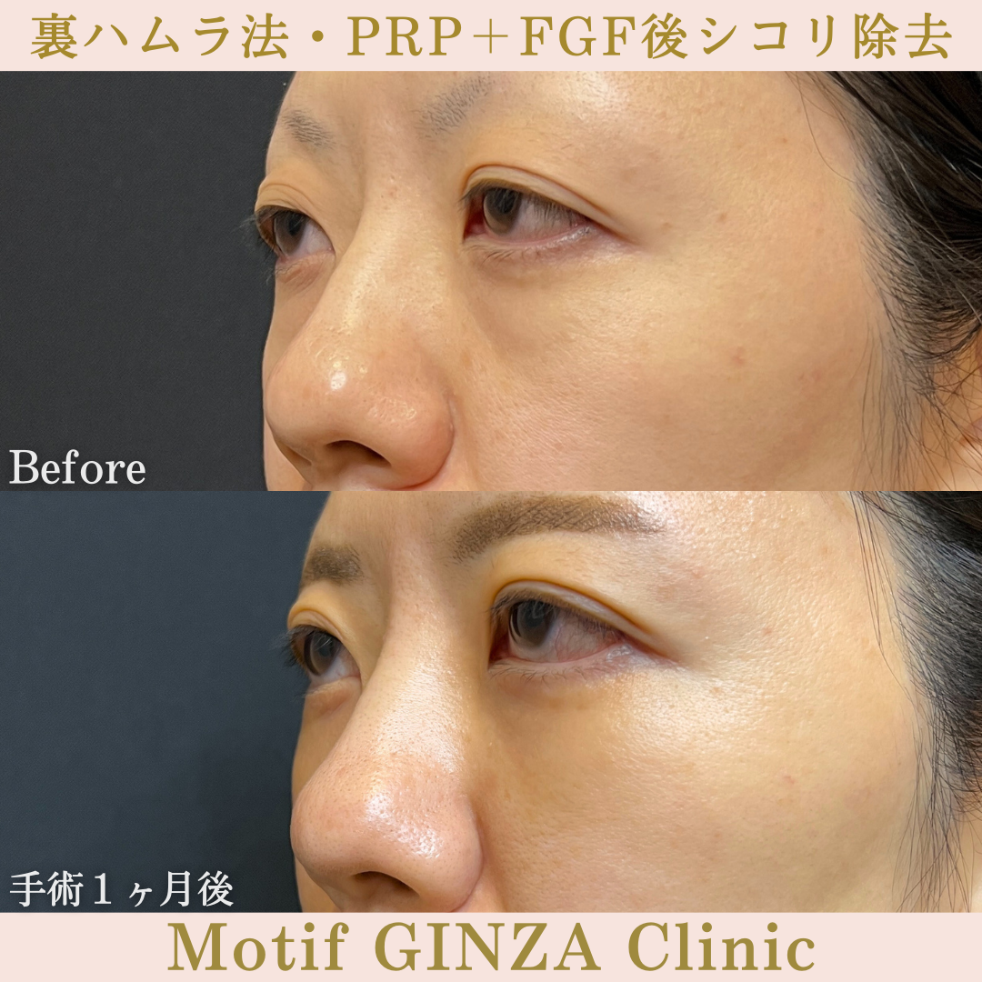 裏ハムラ法・PRP+FGF後シコリ除去(手術3ヶ月)の写真4