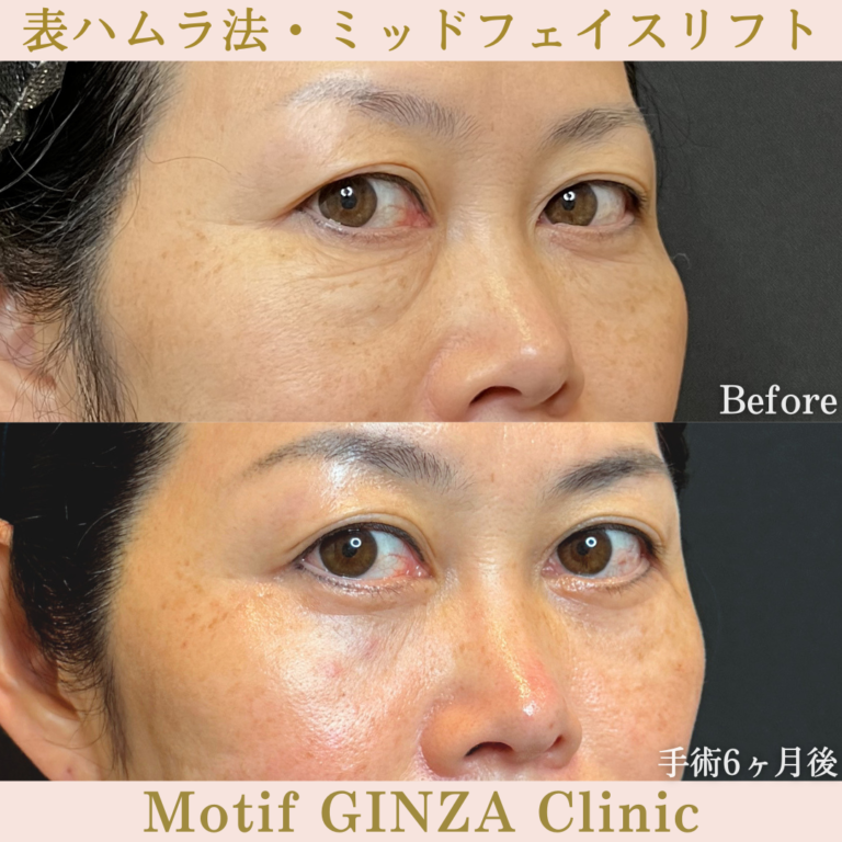 表ハムラ法・ミッドフェイスリフト（手術6か月）の写真2