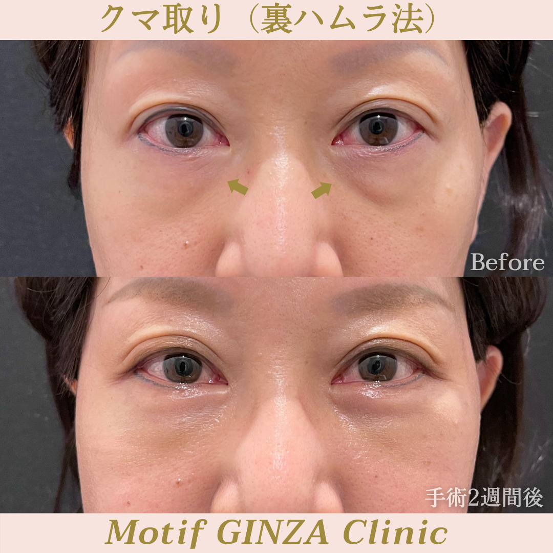 裏ハムラ法(手術3ヶ月)の写真3