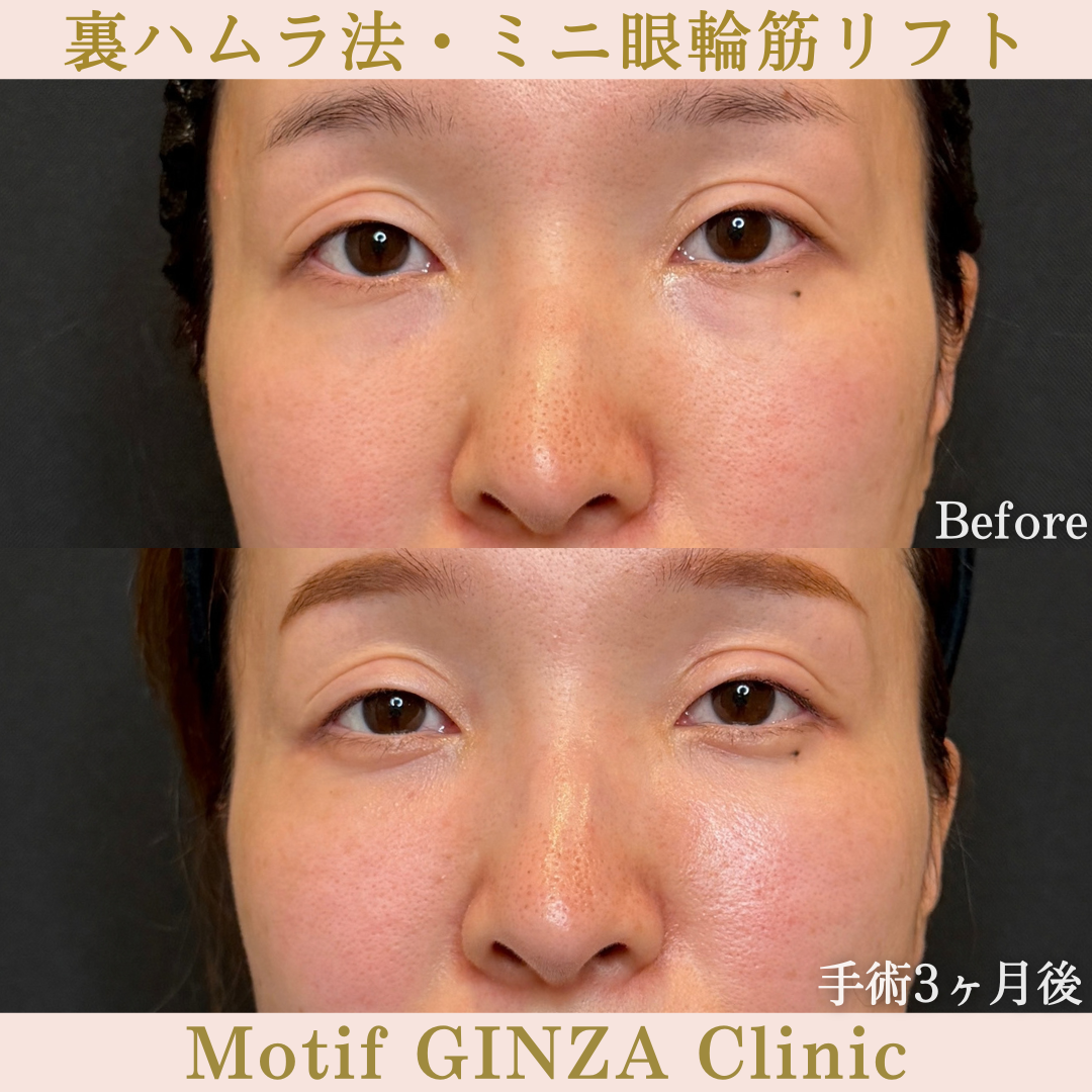 裏ハムラ法・ミニ眼輪筋リフト（手術３か月）の写真