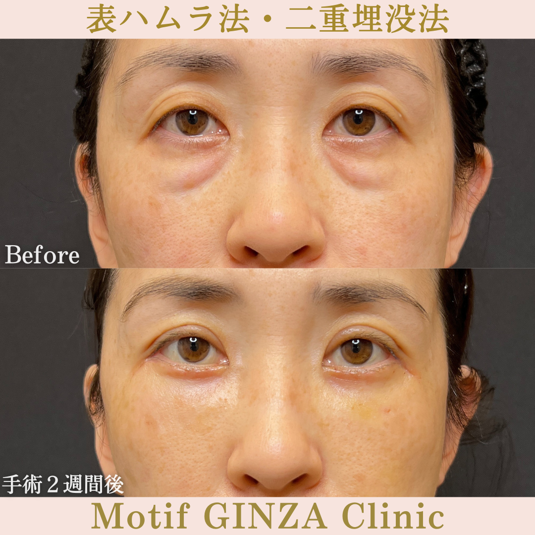 切開式下眼瞼たるみ取り・二重埋没法（手術６ヶ月）の写真4