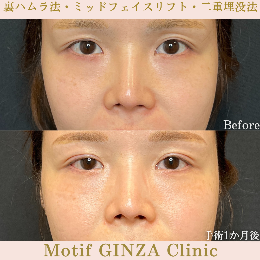 裏ハムラ法・ミッドフェイスリフト・二重埋没法（手術３か月）の写真3