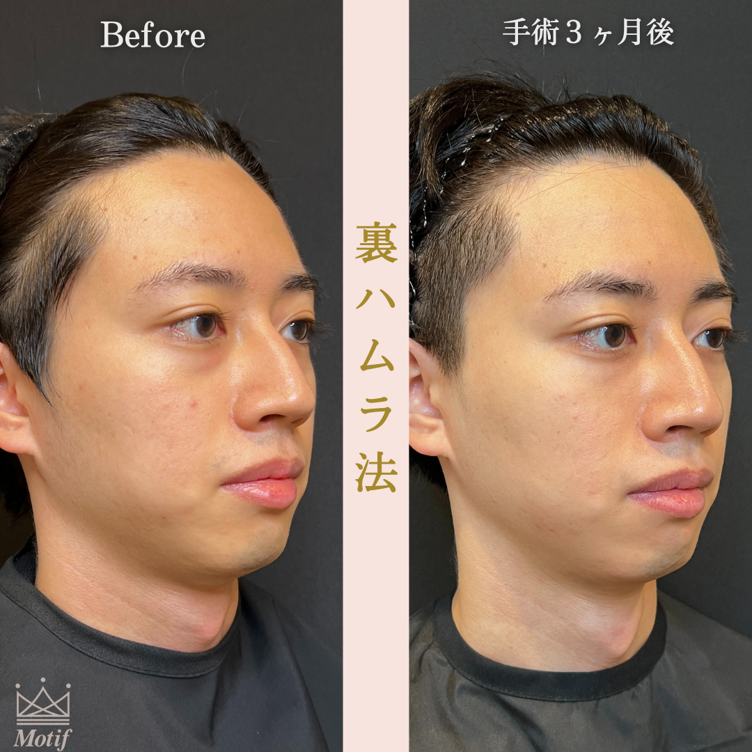 裏ハムラ法（手術３ヶ月）の写真2