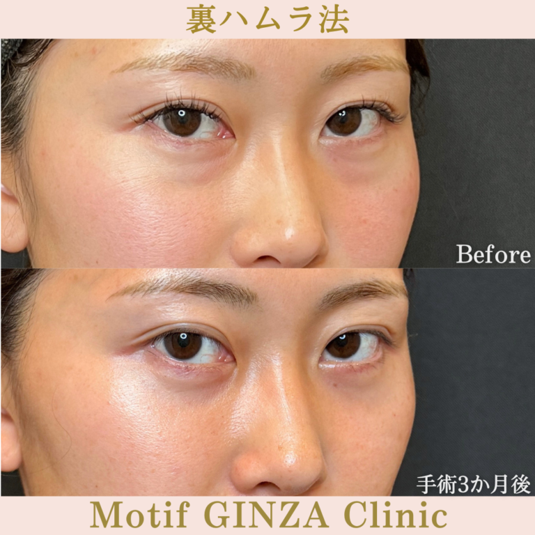 裏ハムラ法（手術3か月）の写真3