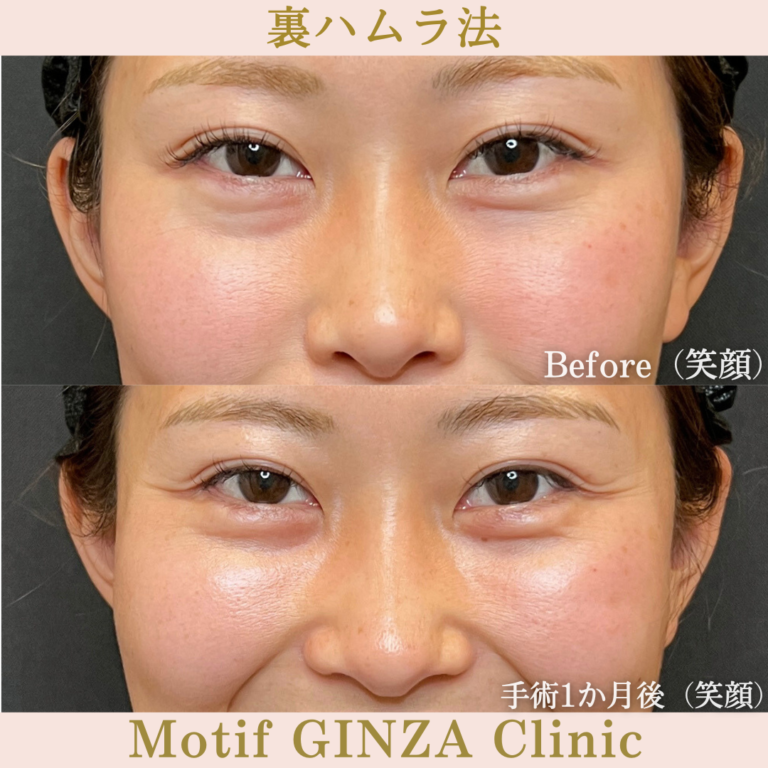 裏ハムラ法（手術１か月）の写真2
