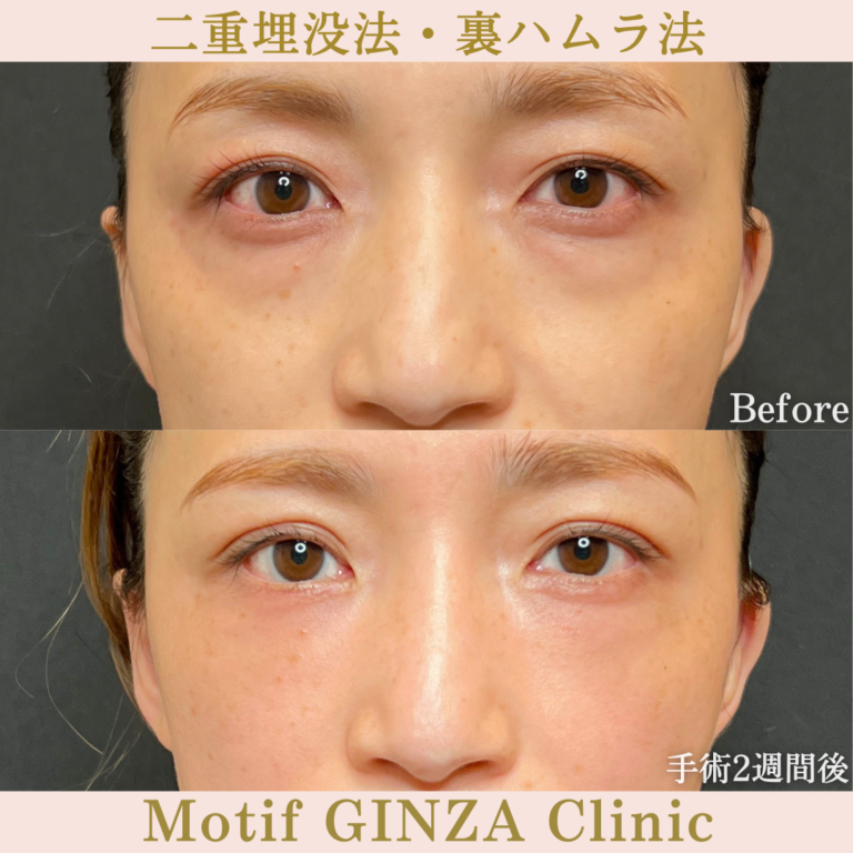 二重埋没法・裏ハムラ法（手術３か月）の写真5