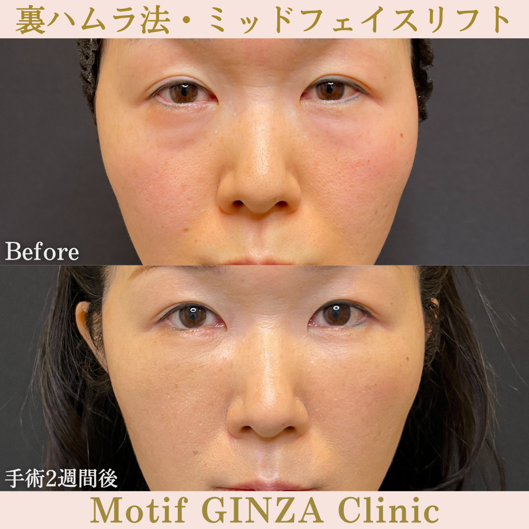 裏ハムラ法・ミッドフェイスリフト(手術6ヶ月)の写真5