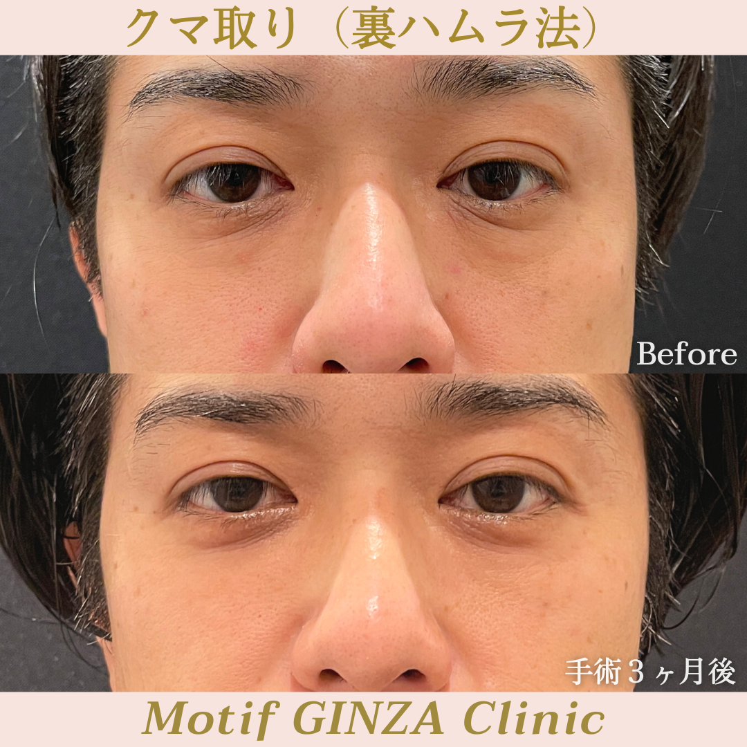 裏ハムラ法(手術12ヶ月)の写真3