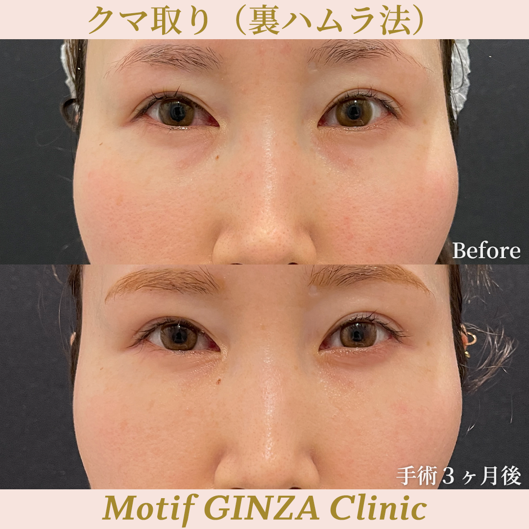 裏ハムラ法（手術３ヶ月）の写真