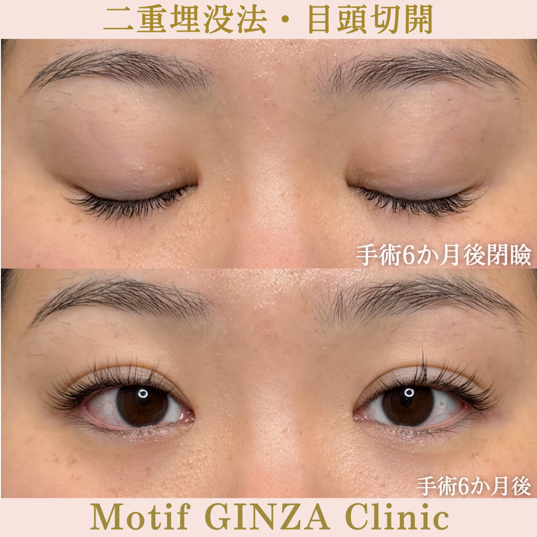 二重埋没法・目頭切開（手術6か月）の写真2