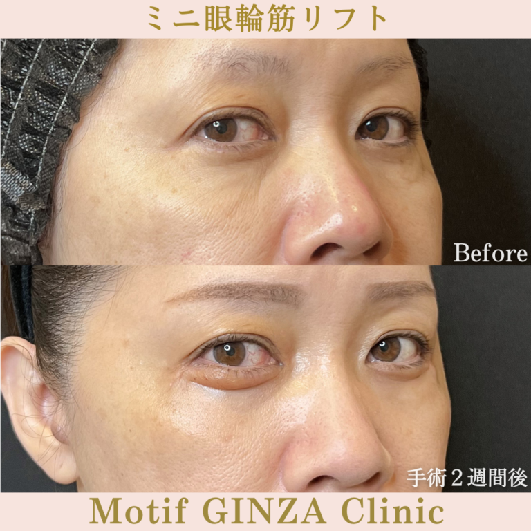 ミニ眼輪筋リフト（手術３か月）の写真6