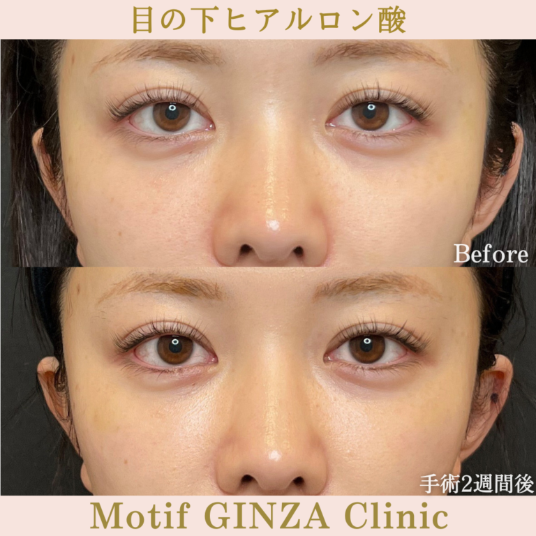 目の下ヒアルロン酸（手術2週間）