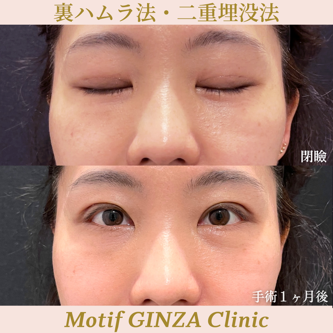 裏ハムラ法・二重埋没法（手術１ヶ月）の写真2