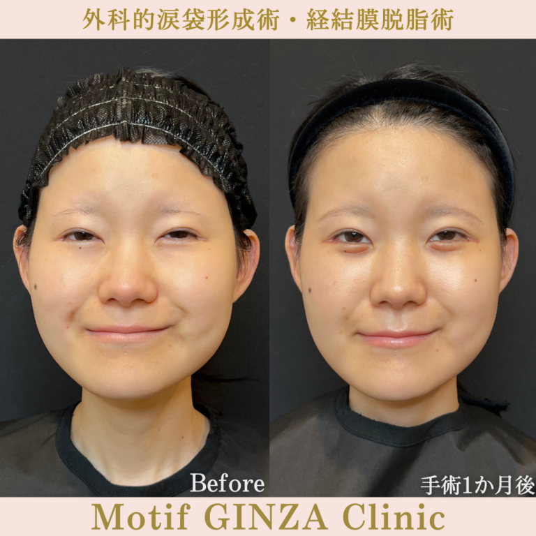 外科的涙袋形成術・経結膜脱脂術（手術３か月）の写真5