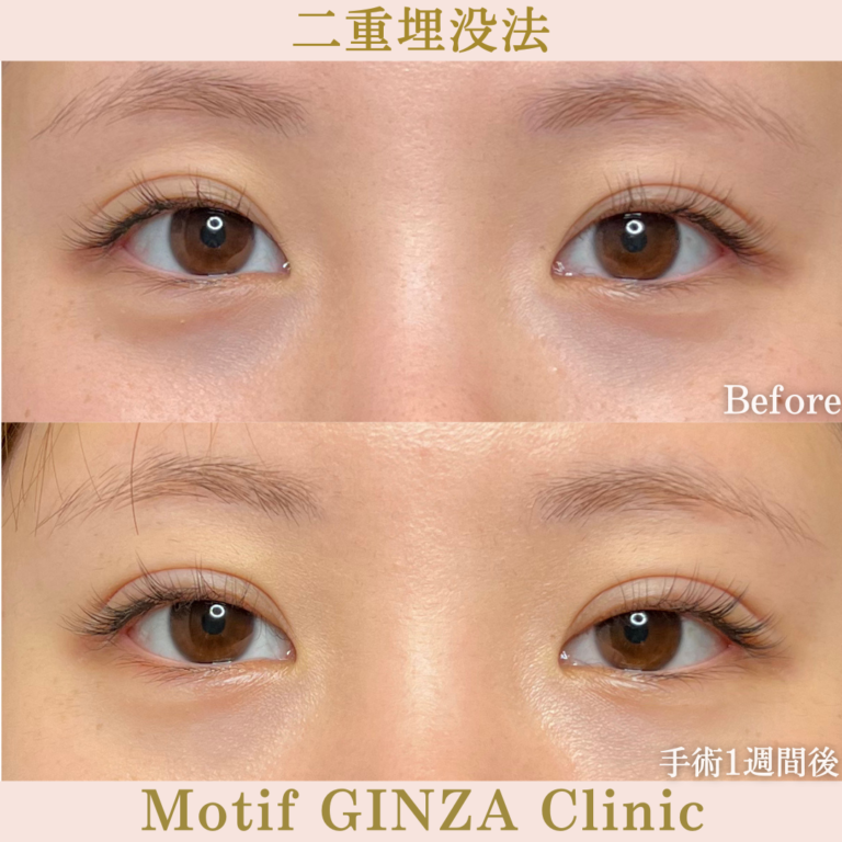 二重埋没法(手術1か月)の写真2