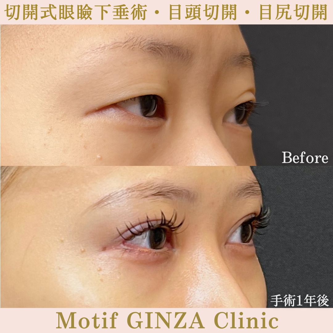 切開式眼瞼下垂・目頭切開・目尻切開（手術１年）の写真2