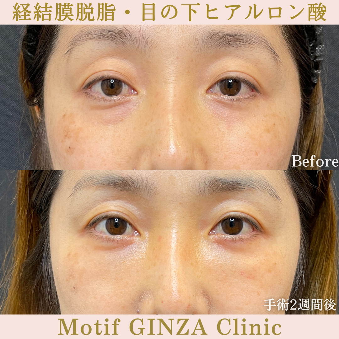 経結膜脱脂・目の下ヒアルロン酸(手術1ヶ月)の写真3