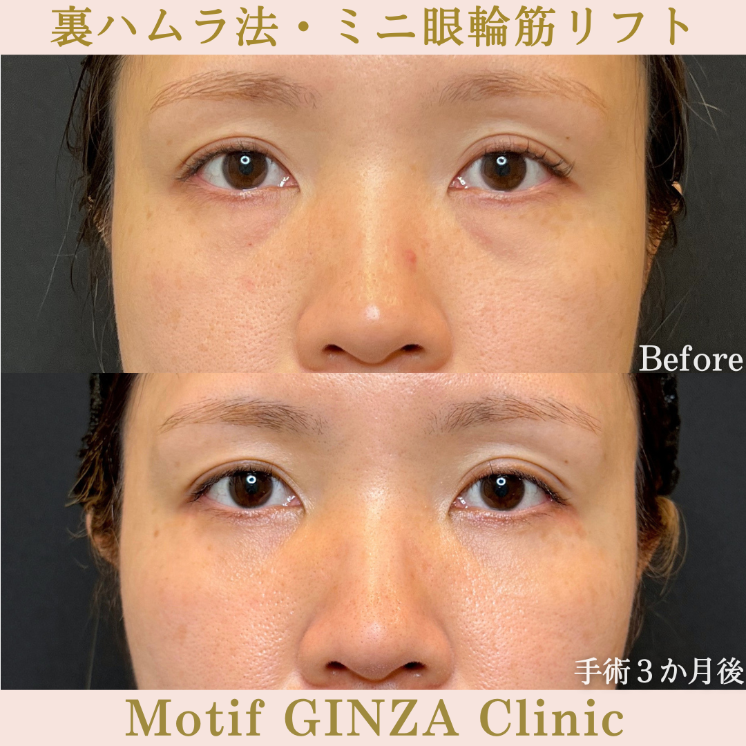 裏ハムラ法・ミニ眼輪筋リフト（手術6か月）の写真3