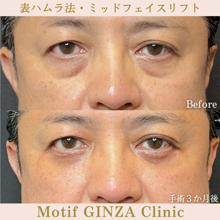 表ハムラ法・ミッドフェイスリフト（手術6か月）の写真3