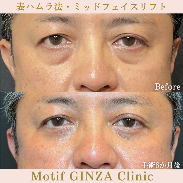 表ハムラ法・ミッドフェイスリフト（手術6か月）