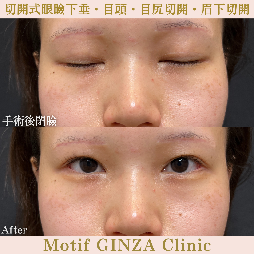 切開式眼瞼下垂・目頭切開・目尻切開・眉下切開（手術10ヶ月）の写真2