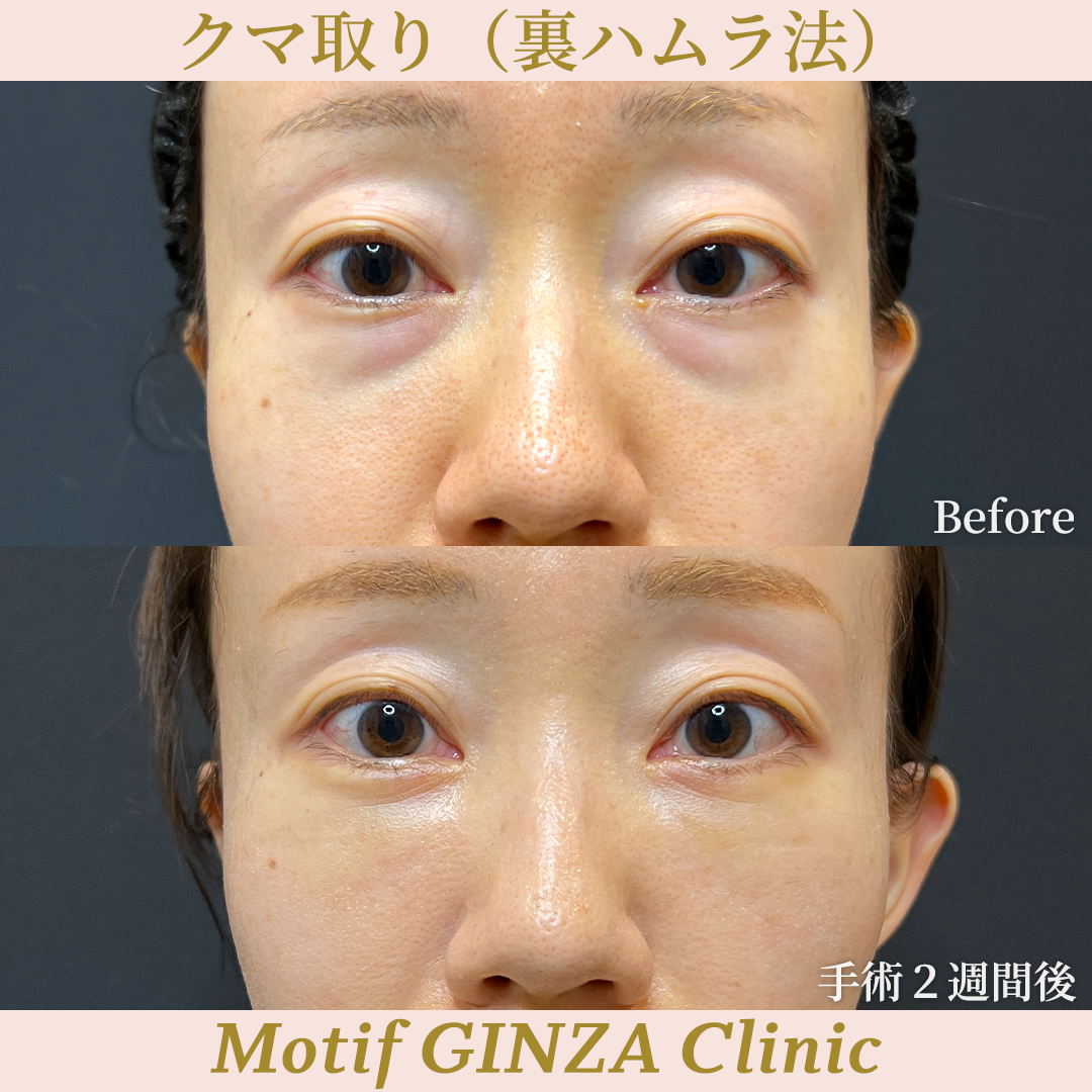 裏ハムラ法（手術２年）の写真5