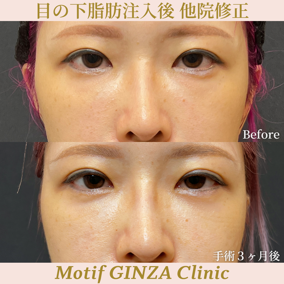 目の下脂肪注入後 他院修正（裏ハムラ法）（手術３ヶ月）の写真