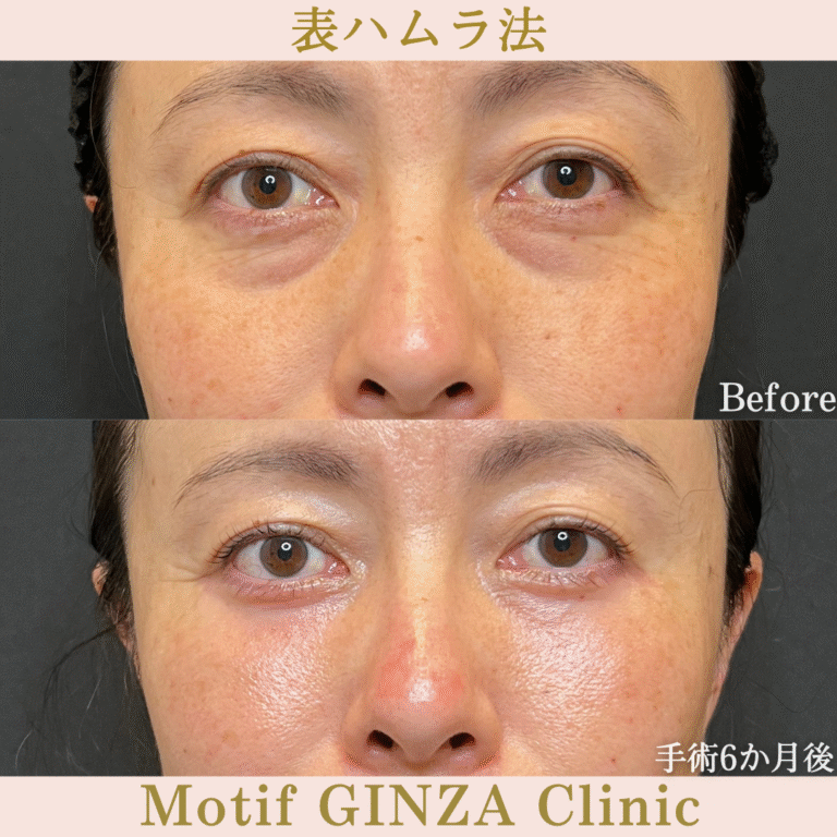 切開式下眼瞼たるみ取り（手術６か月）