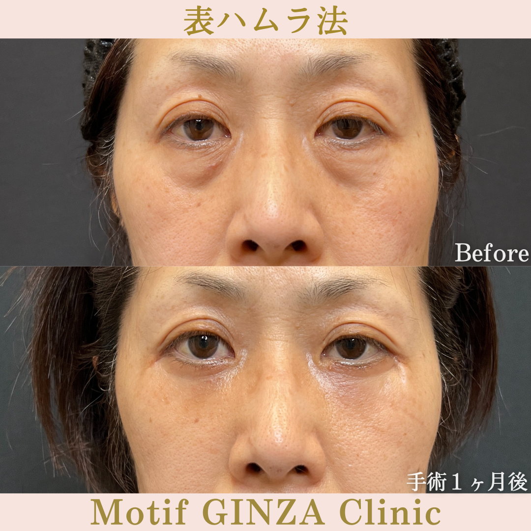 切開式下眼瞼たるみ取り(手術3ヶ月)の写真3