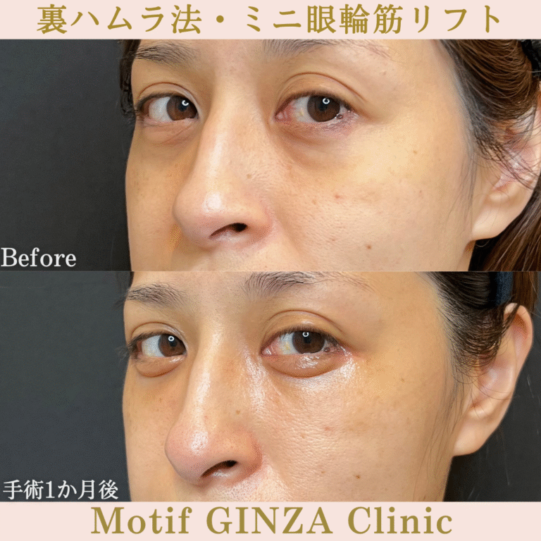 裏ハムラ法・ミニ眼輪筋リフト（手術１か月）の写真2