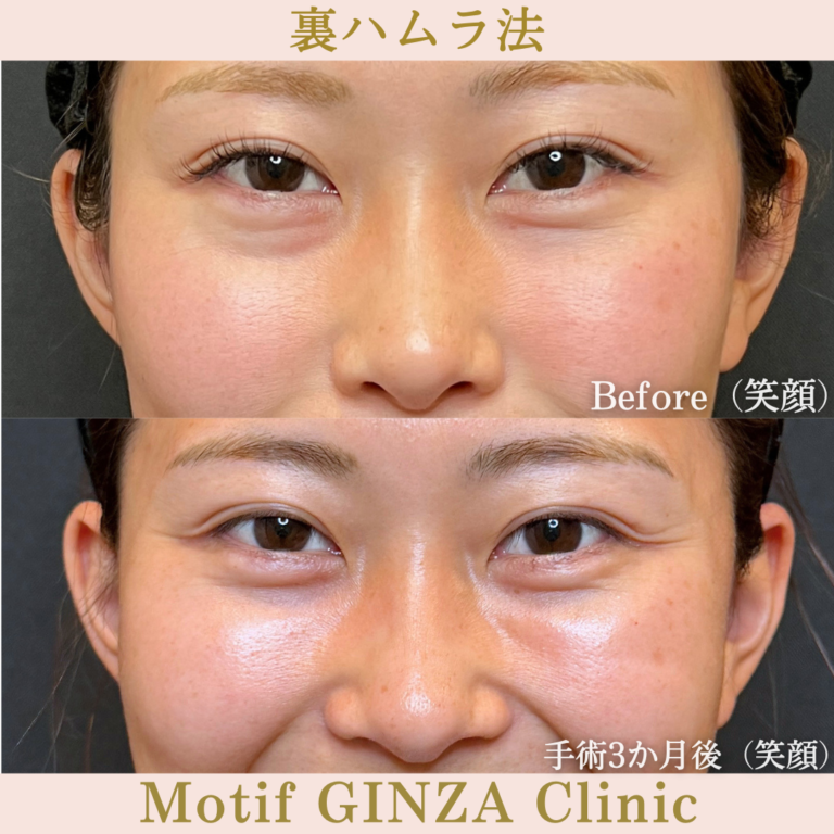 裏ハムラ法（手術3か月）の写真2