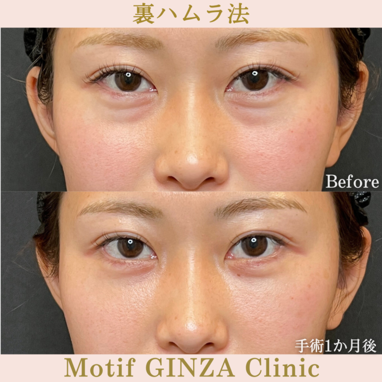 裏ハムラ法（手術１か月）