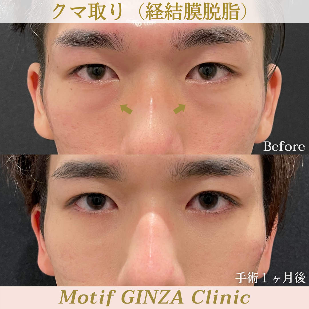 経結膜脱脂術(手術1ヶ月)の写真1