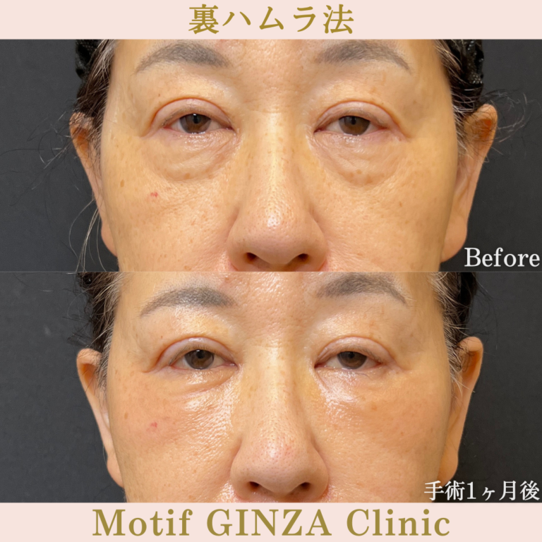 裏ハムラ法(手術2年後)の写真5