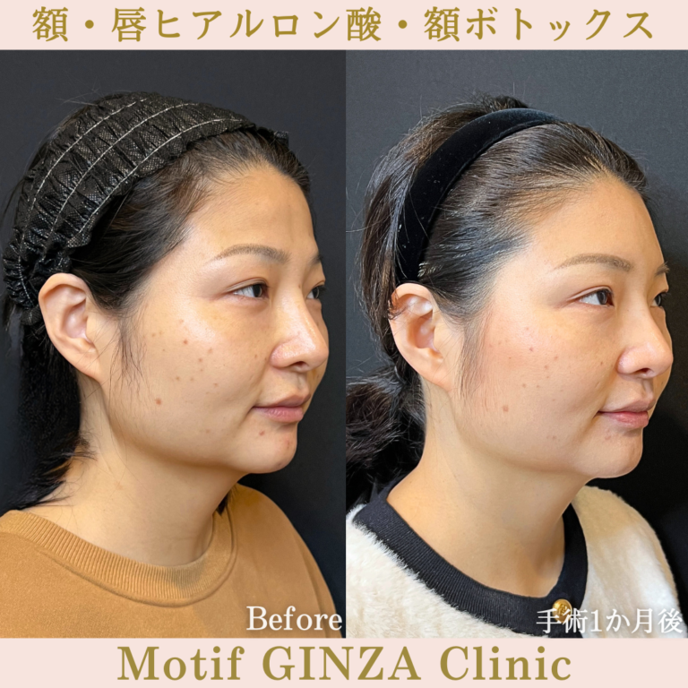 額・唇ヒアルロン酸・額ボトックス（手術１か月）