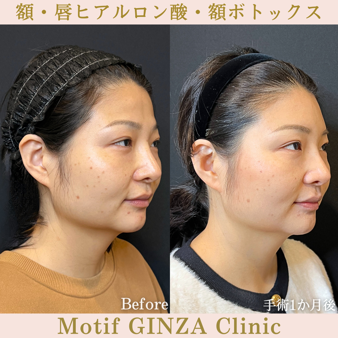 額・唇ヒアルロン酸・額ボトックス（手術１か月）の写真