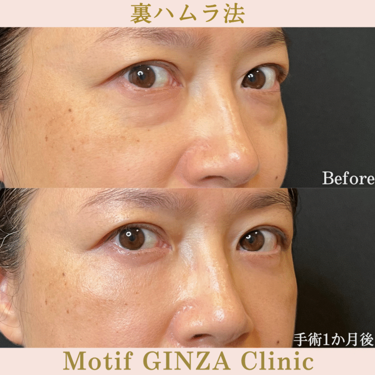裏ハムラ法（手術３か月）の写真4