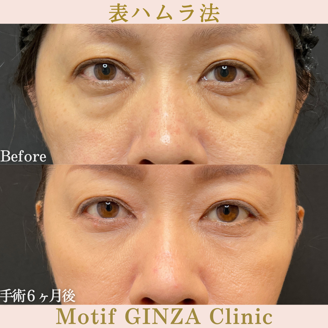 切開式下眼瞼たるみ取り(手術2年6か月)の写真5