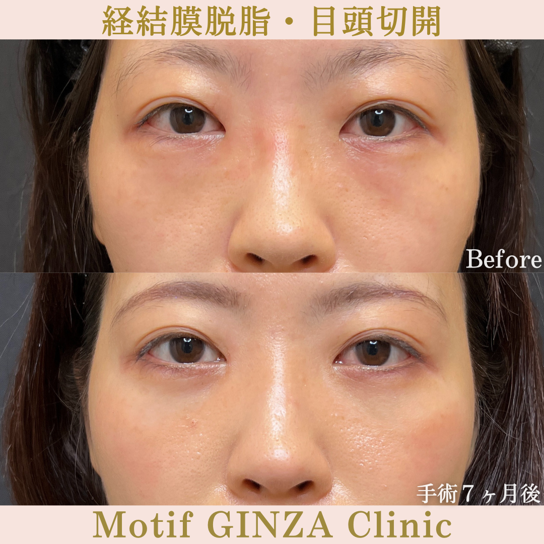 経結膜脱脂・目頭切開（手術７ヶ月）の写真