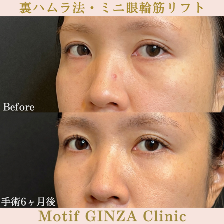 裏ハムラ法・ミニ眼輪筋リフト（手術6か月）の写真2