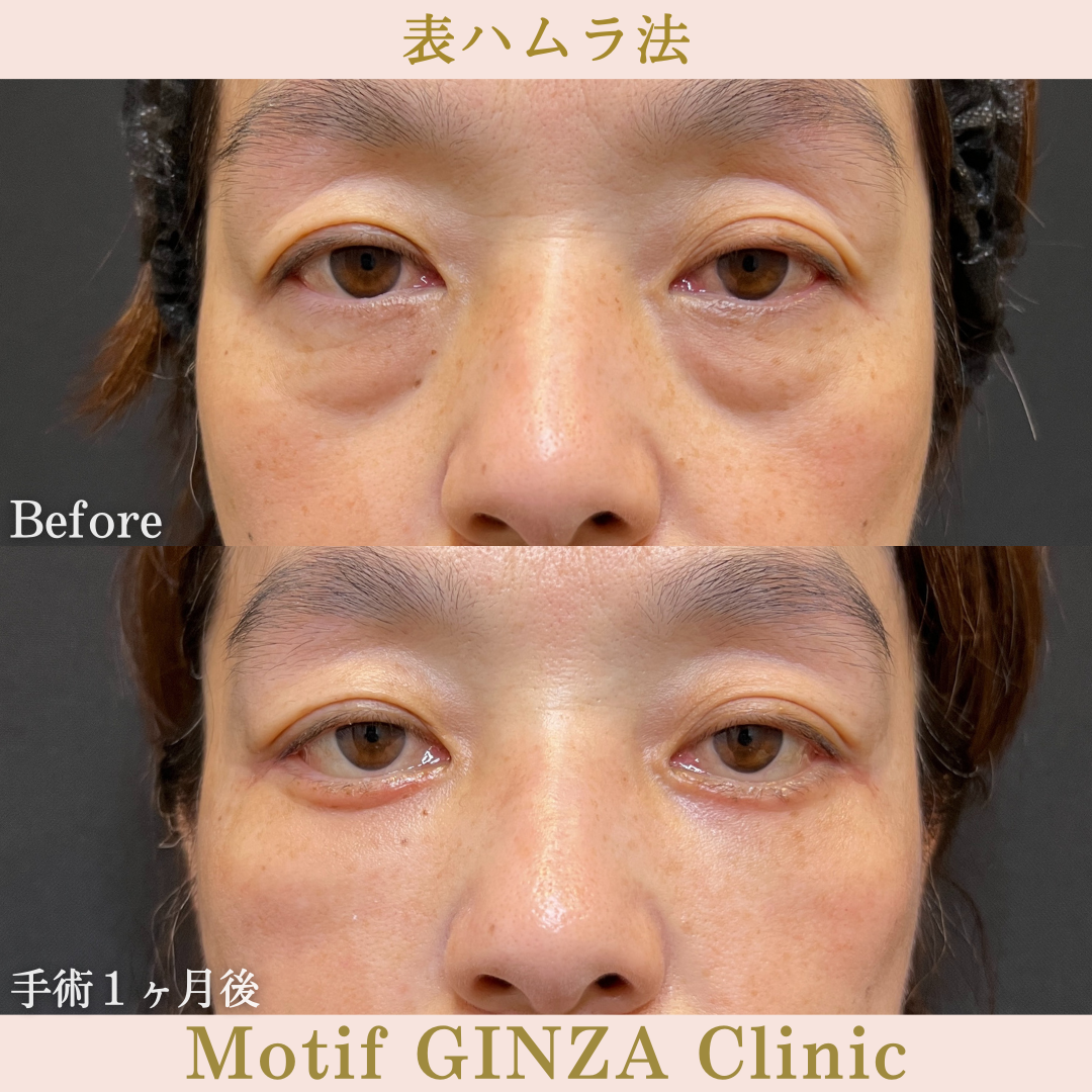 切開式下眼瞼たるみ取り・ミッドフェイスリフト（手術３ヶ月）の写真2