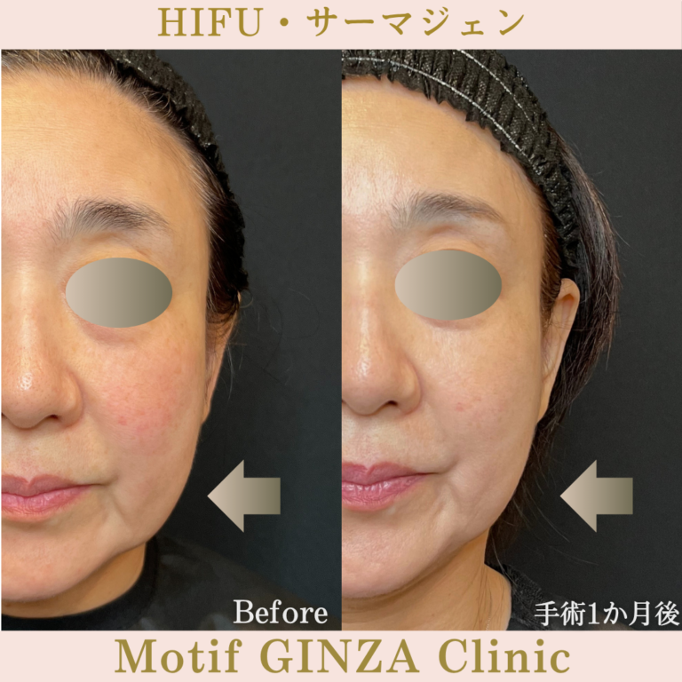 HIFU・サーマジェン（手術１か月）の写真2
