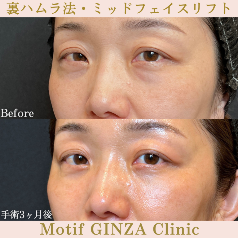 裏ハムラ法・ミッドフェイスリフト(手術3か月)の写真2