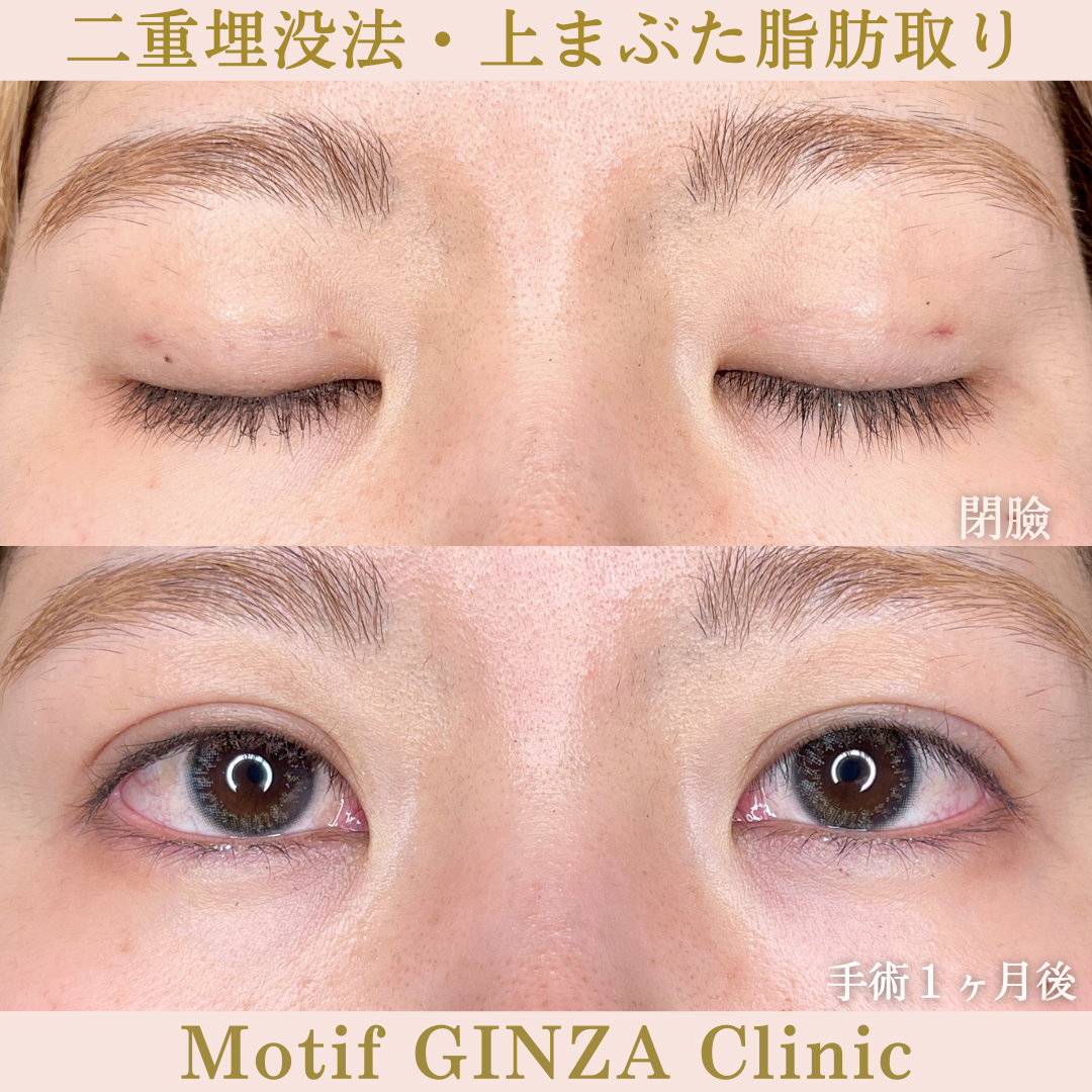 二重埋没法・上まぶた脂肪取り（手術１ヶ月）の写真2