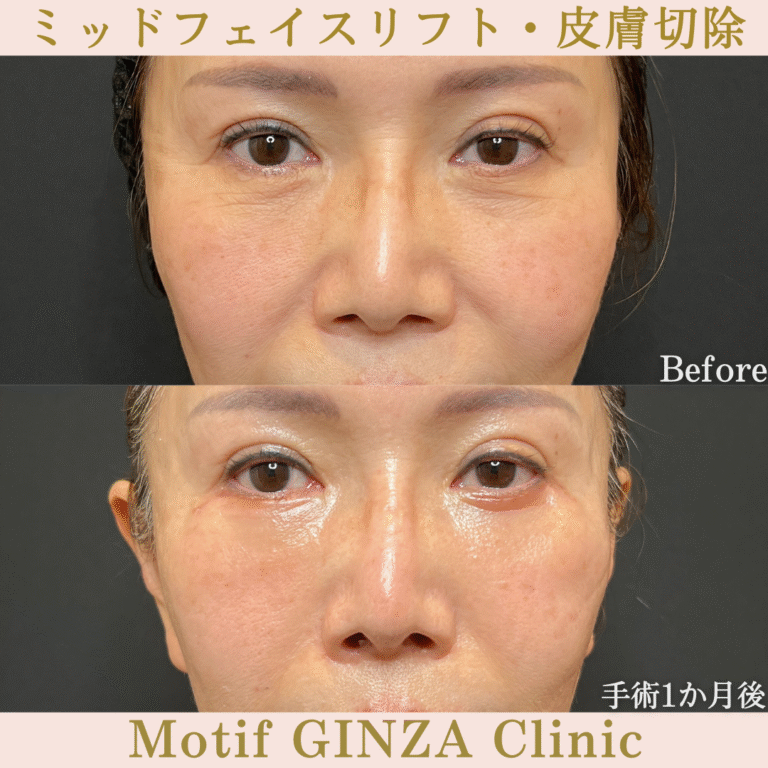 ミッドフェイスリフト・皮膚切除（手術６か月）の写真5