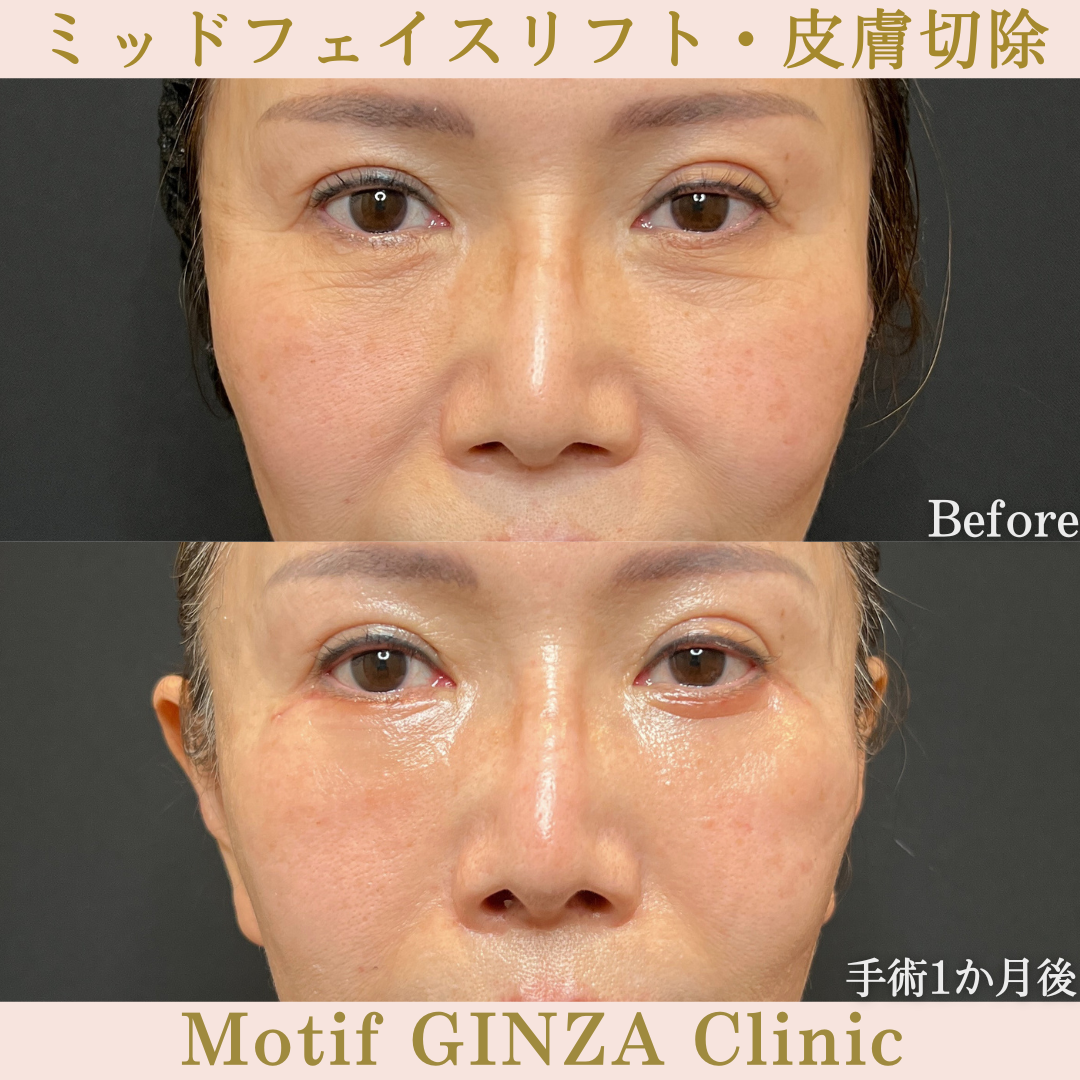 ミッドフェイスリフト・皮膚切除(手術6か月)の写真5