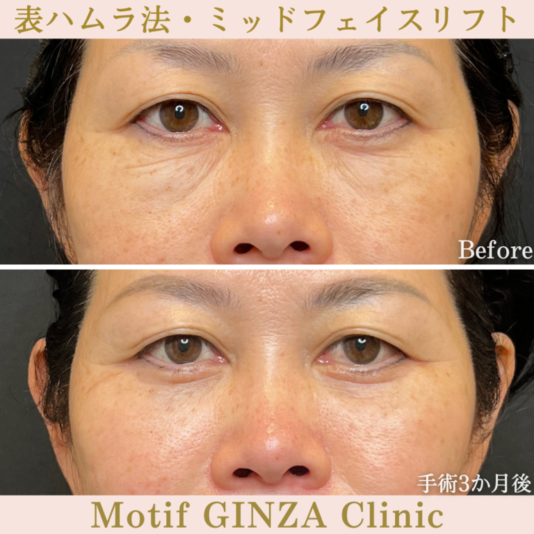 表ハムラ法・ミッドフェイスリフト（手術3か月）