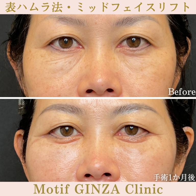 表ハムラ法・ミッドフェイスリフト（手術1か月）