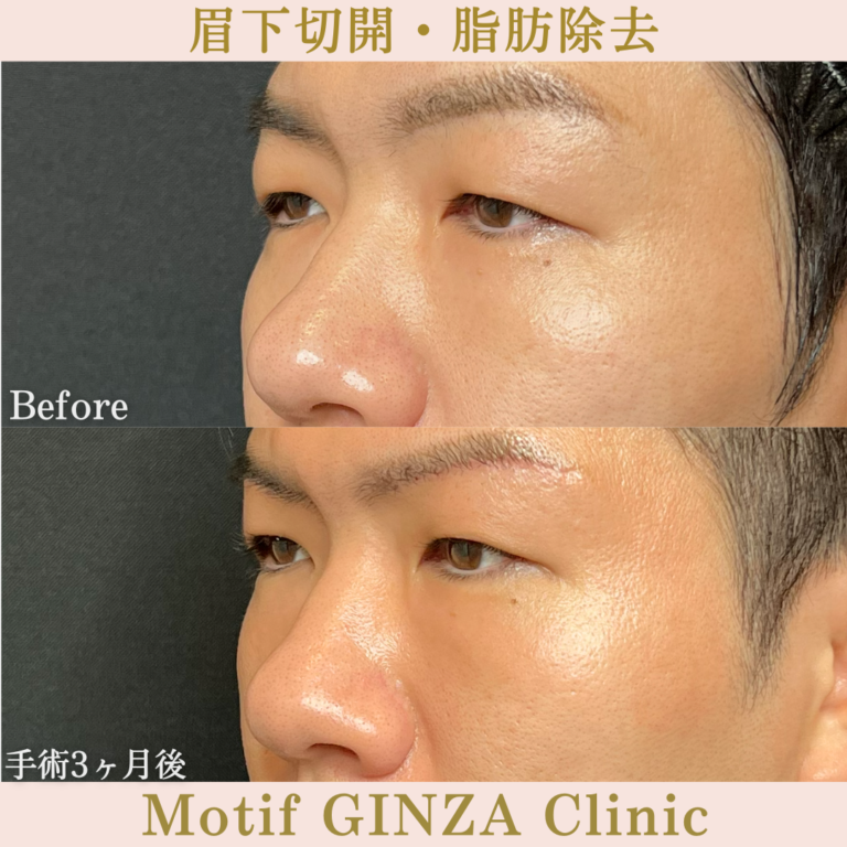 眉下切開・脂肪除去(手術3か月)の写真2